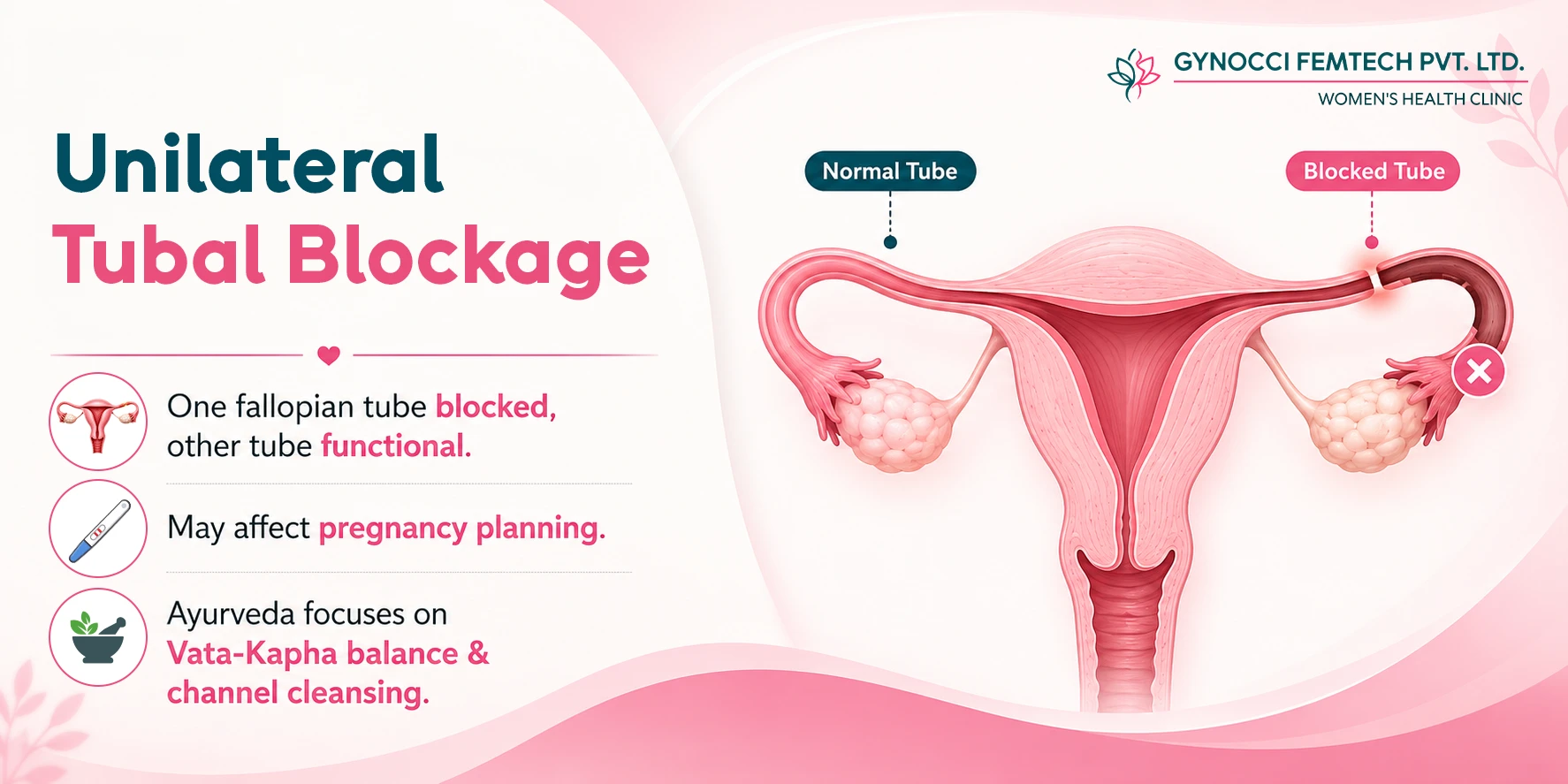 Unilateral Tubal Blockage